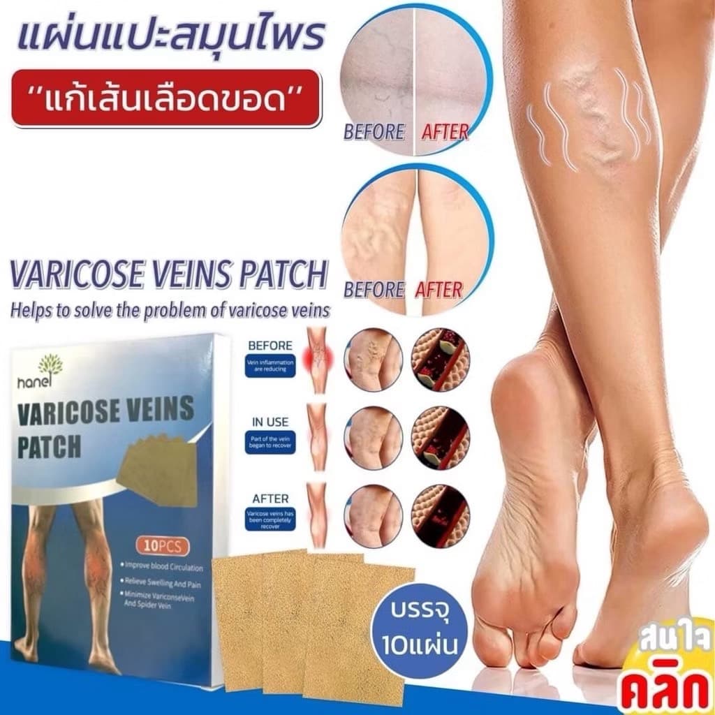 HANEL VARICOSE VEINS PATCH