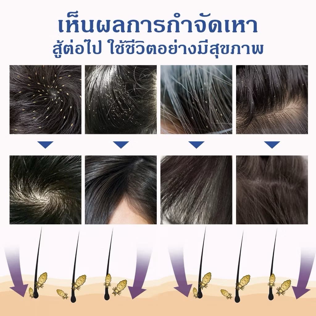 SOUTH MOON SCABIES LICE SPRAY - ภาพที่ 7